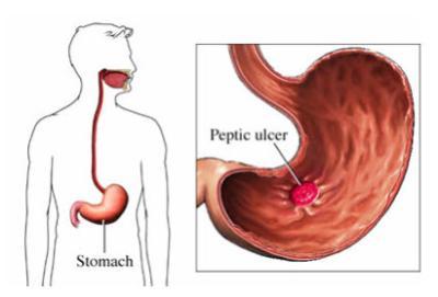 Peptic Ulcer Disease | Infonet Biovision Home.