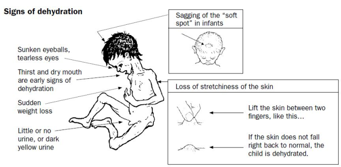 Signs of dehydration