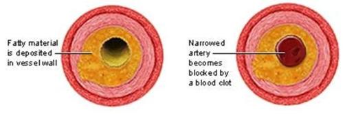Stages of Atherosclerosis