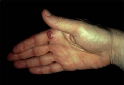 Orf on human hand